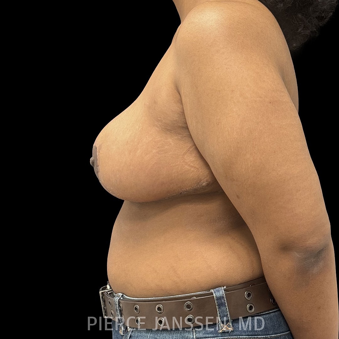 Breast Reduction Before & After