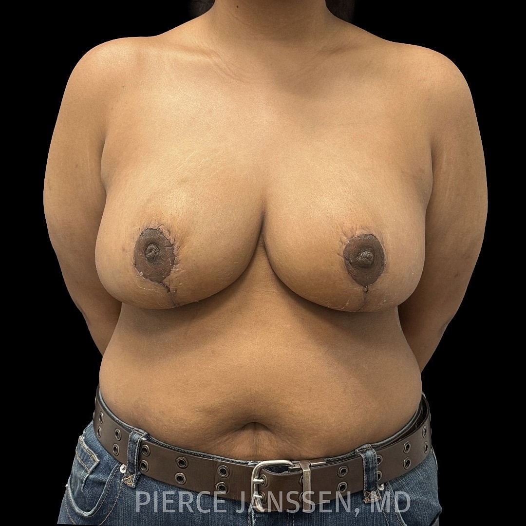 Breast Reduction Before & After