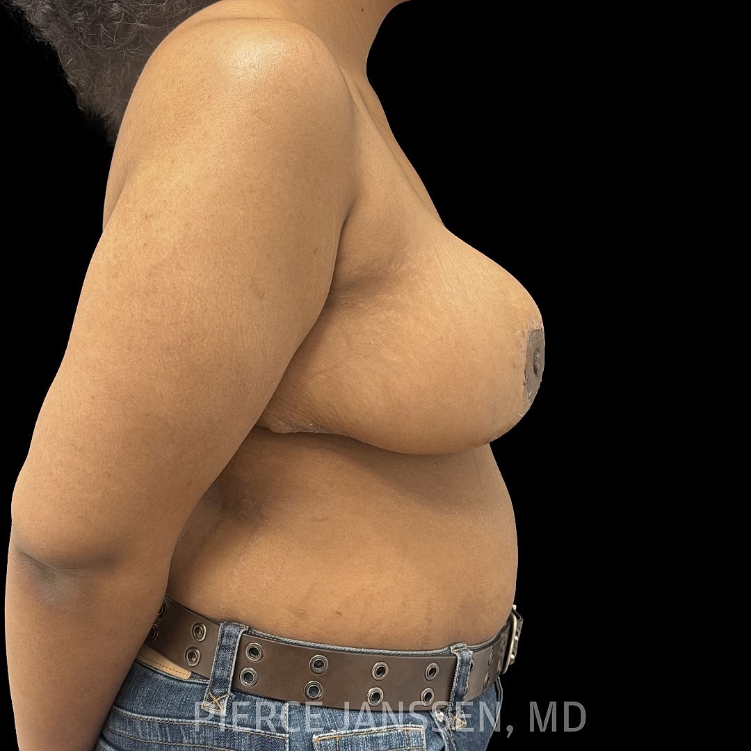 Breast Reduction Before & After