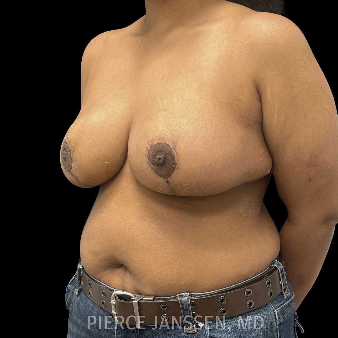 Breast Reduction Before & After